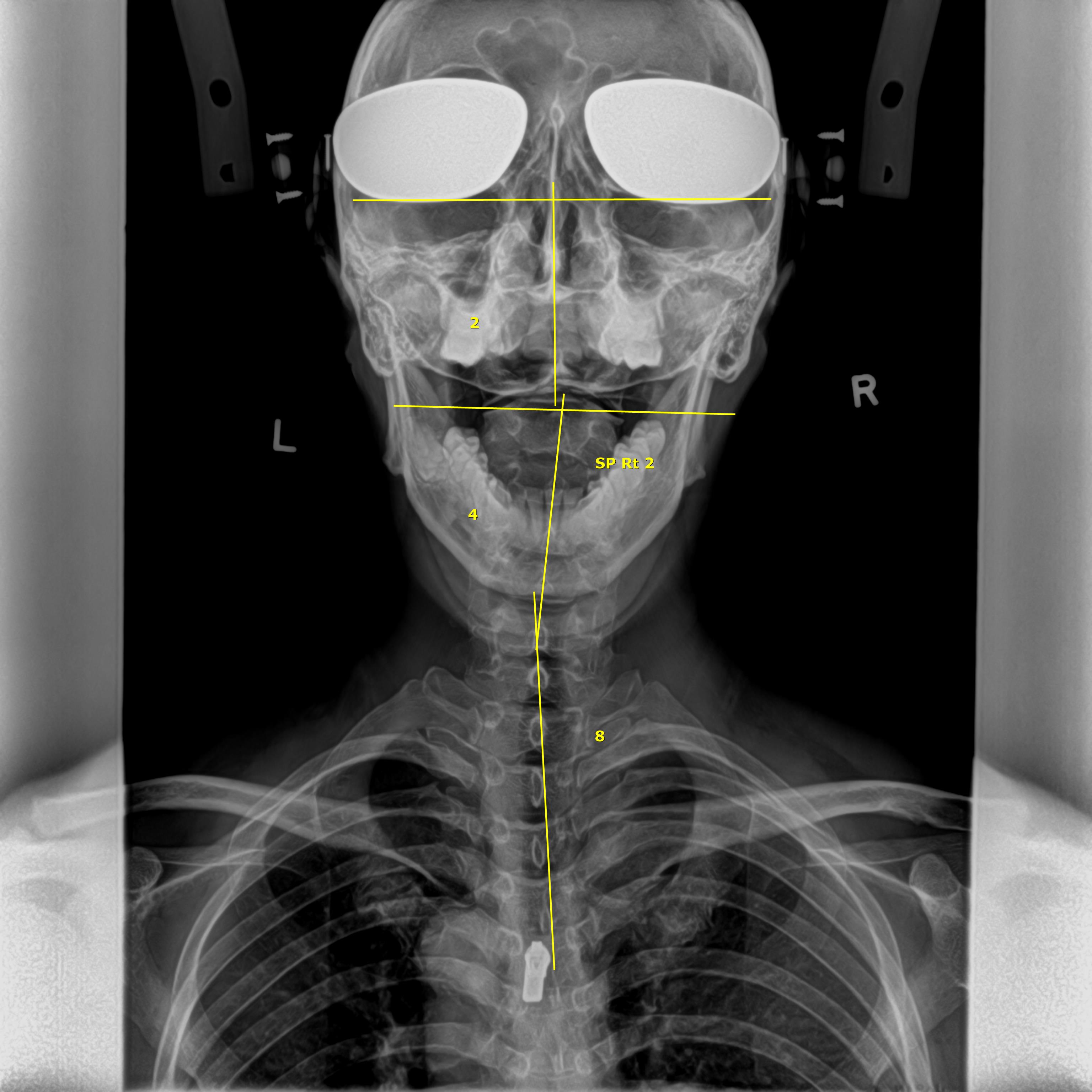 What are X-rays?