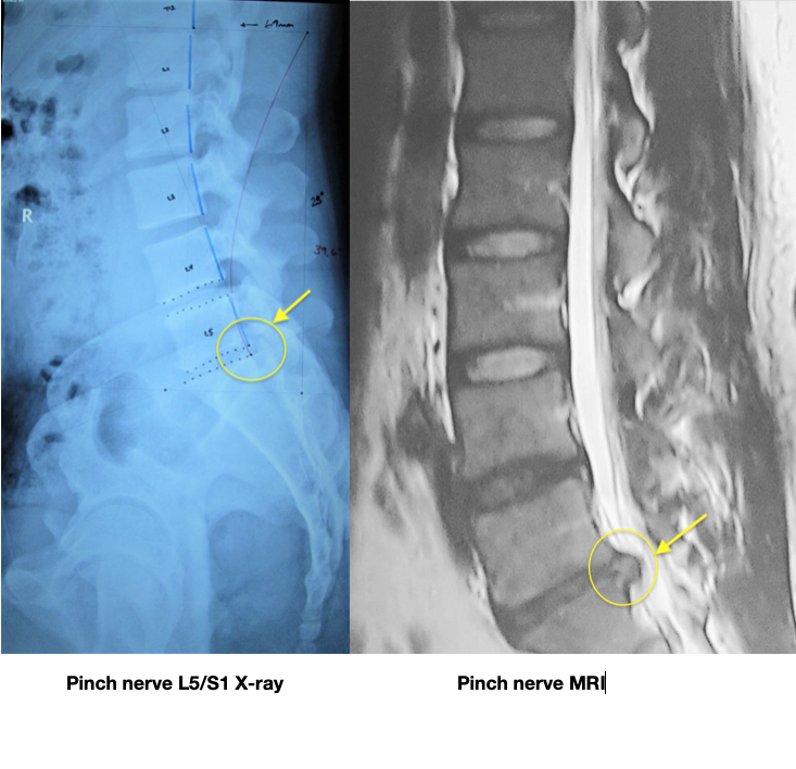 What is a slipped disc?