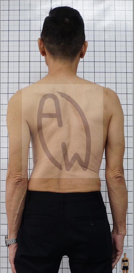Scoliosis Treatment