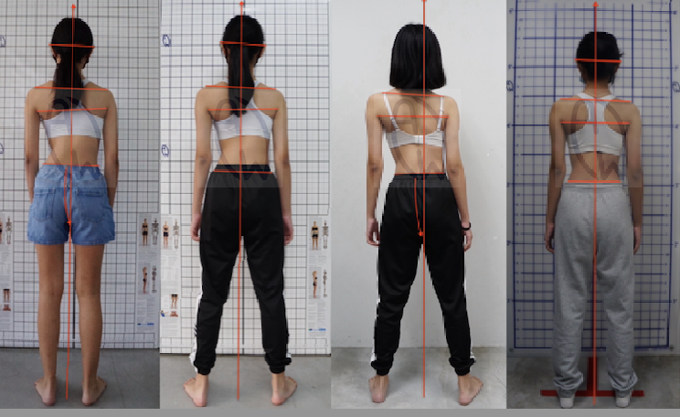 Understanding Scoliosis and Its Impact on Posture