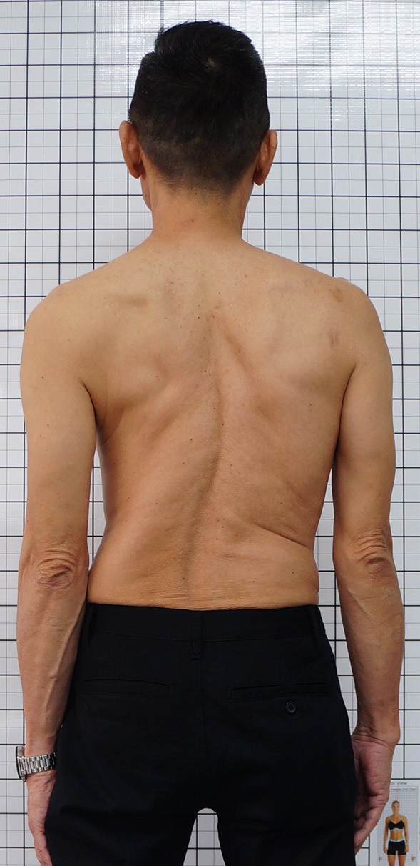 Scoliosis Treatment